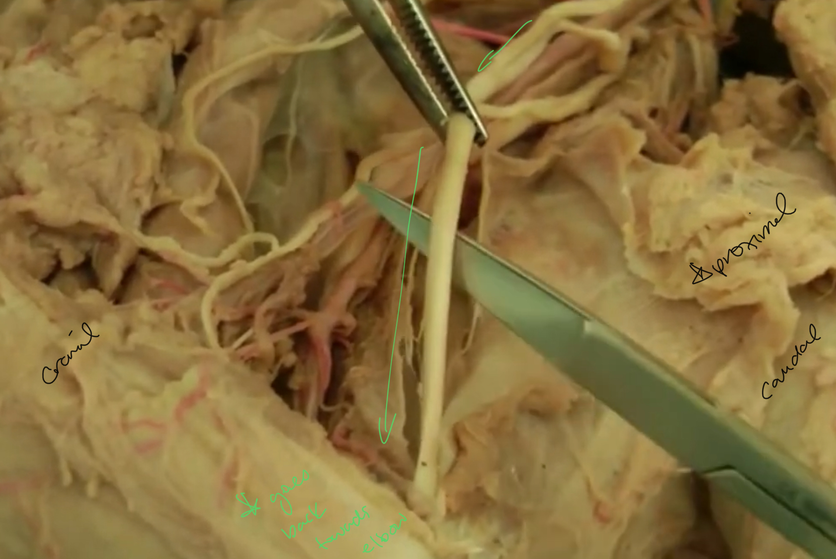 <p>what nerve is highlighted?</p>