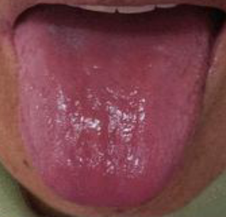 <p>smooth red tongue accompanied by tiredness, headache, lightheadedness </p>