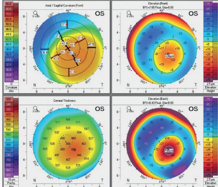 <p>How does TOMOGRAPHY help with EARLY detection of keratoconus</p>