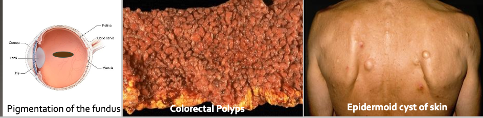 <ul><li><p><strong>AD / Mutation chromosome # 5 (APC)</strong></p></li><li><p>Clinical features:</p><ul><li><p>Colorectal (adenoma) polyps which can become malignant ( 100% if not treated)</p></li><li><p>Multiple osteoma</p></li><li><p>Epidermoid cyst of skin</p></li><li><p>20% have supernumerary teeth</p></li><li><p>Thyroid carcinoma</p></li><li><p>Pigmented ocular fundus (90%)</p></li></ul></li></ul><p></p>