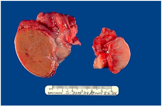 <ol><li><p>Identify the cellular adaptation</p></li><li><p>What causes this particular adaptation?</p></li></ol><p></p>