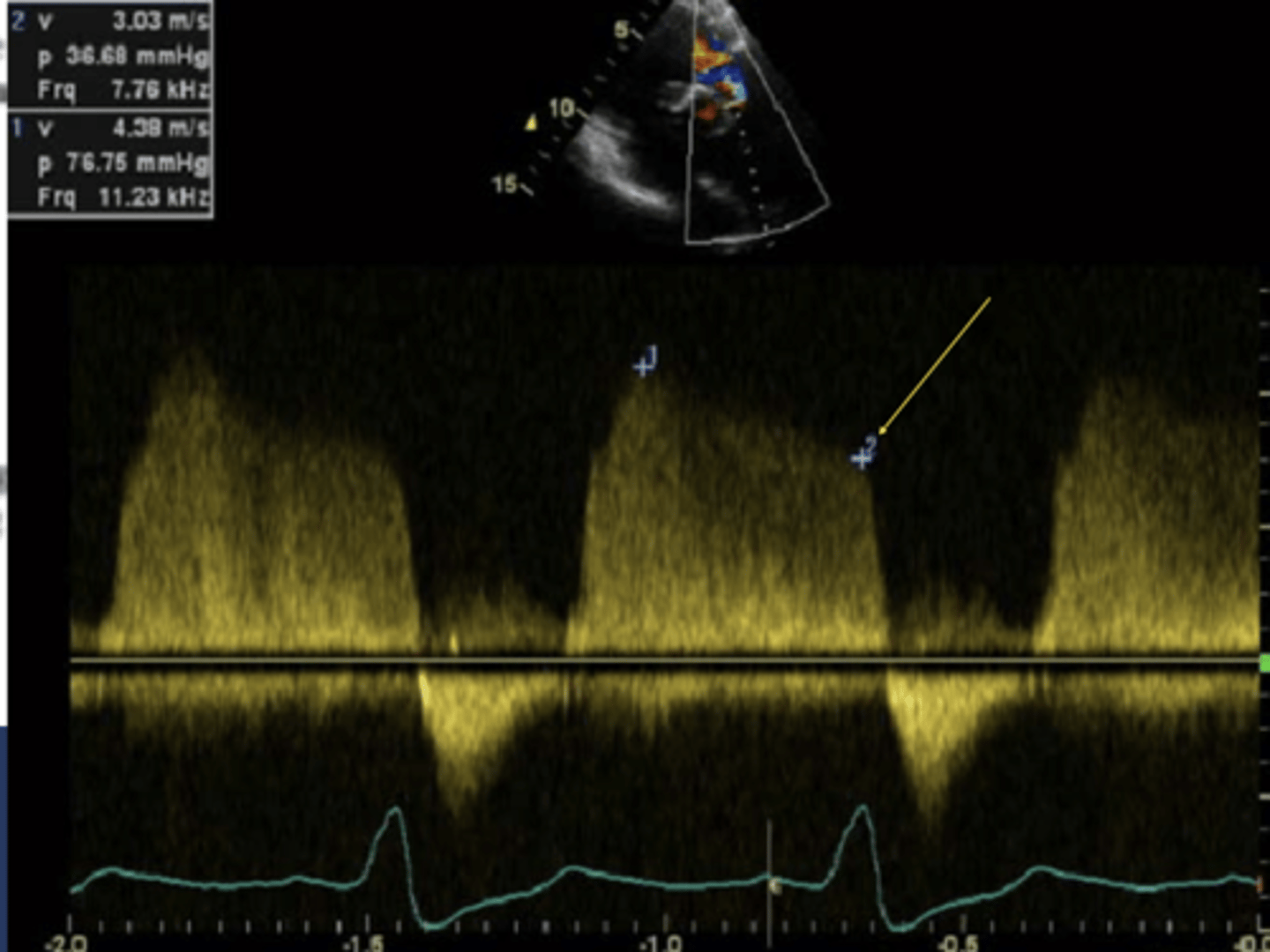 <p>End-diastolic PI velocity</p><p>RA pressure</p>