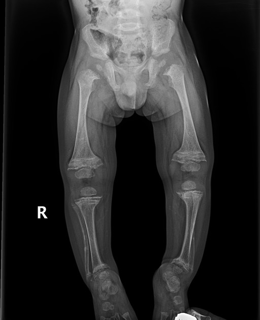 <p>Vitamin D deficiency (nutritional rickets).</p>
