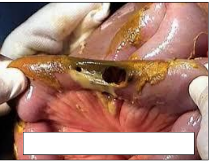 Perforación intestinal