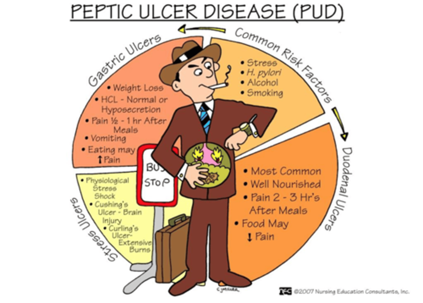 <p>Peptic Ulcer Disease (PUD)</p>