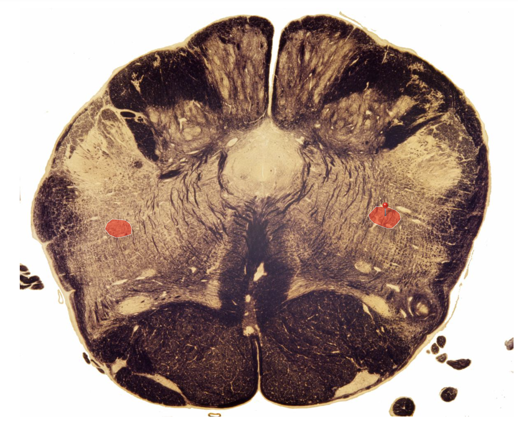 <p>Nucleus Ambiguus (Accessory Nerve Nucleus)</p><p></p><p><span><strong>Motor</strong></span></p><p><span>Muscles of Pharynx for Speech and Swallowing</span></p>