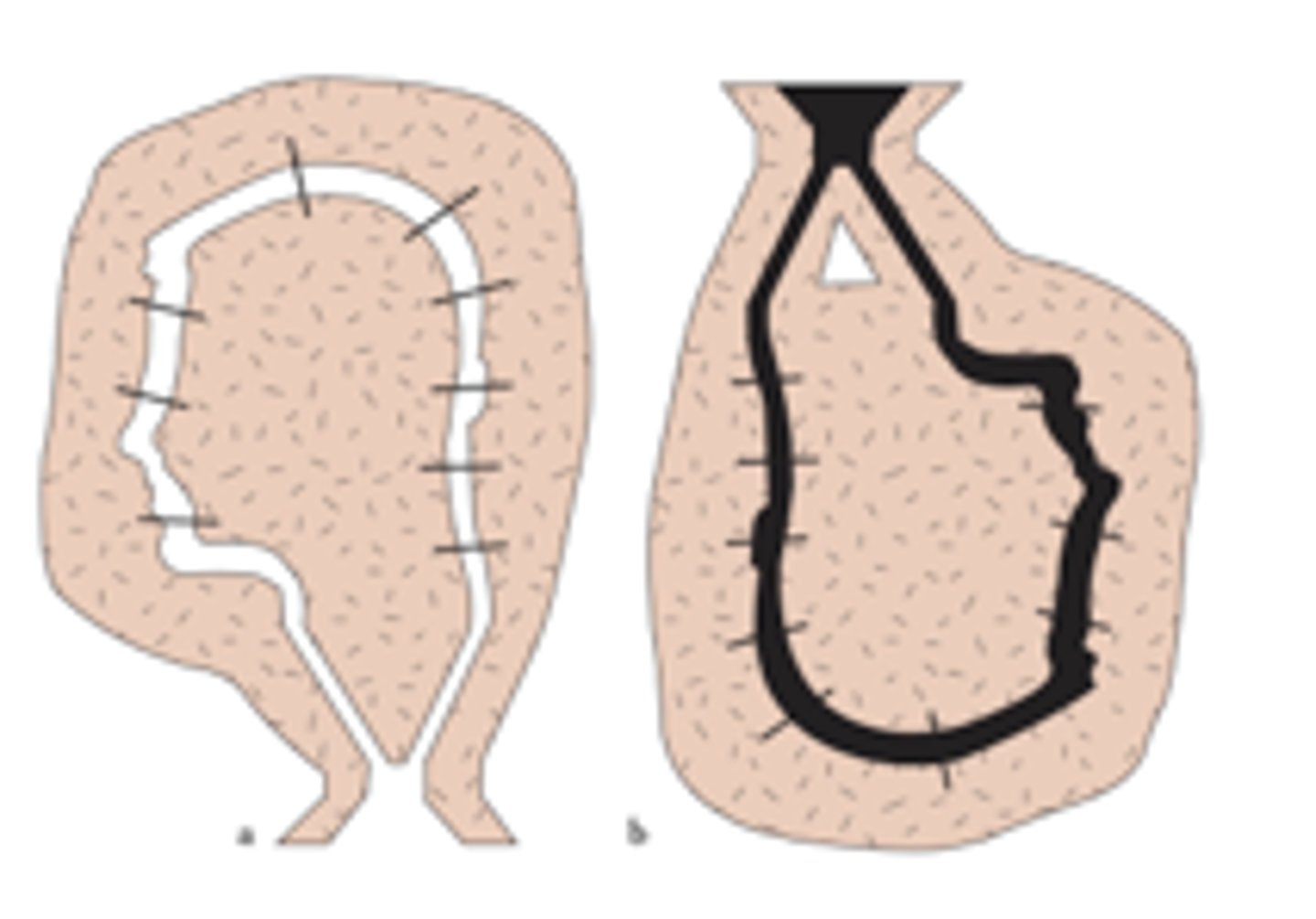 <p>a process of casting in which a clay mold is built up around a pattern of wax and then baked so as to melt and drain off the wax. The molten metal (bronze, copper, etc.) is then poured into the cavity.</p>