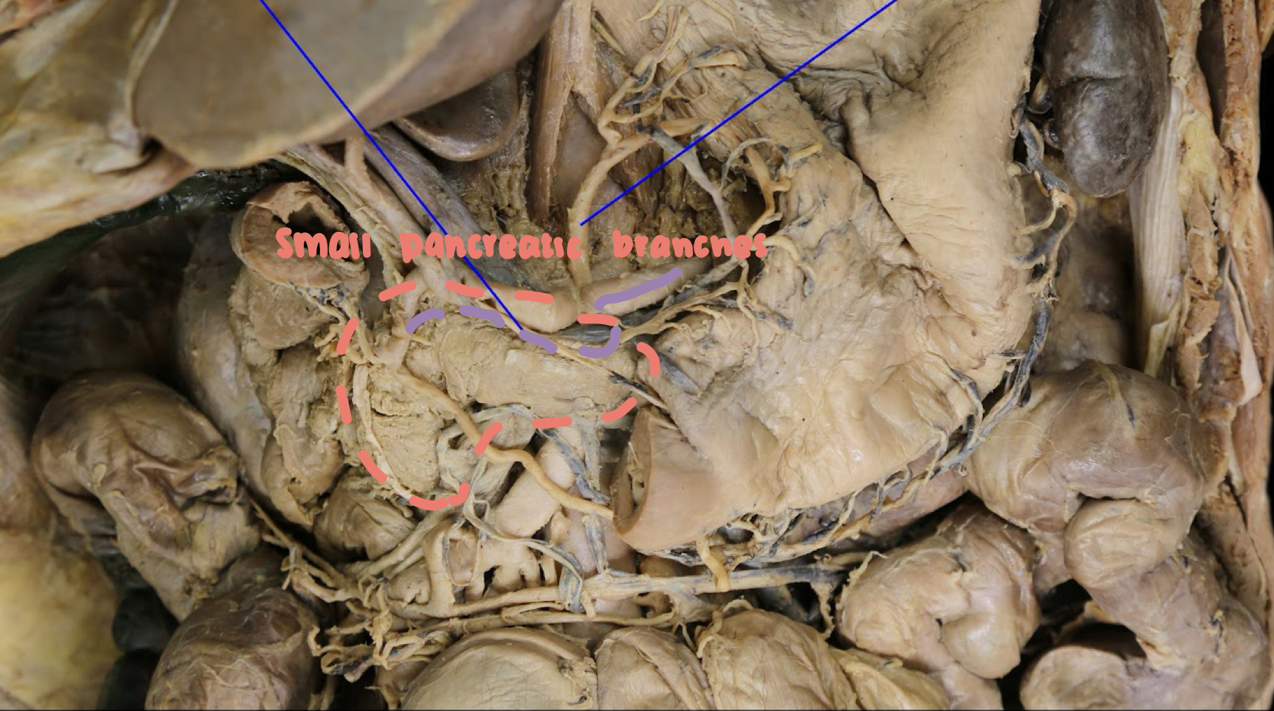 <p>A). body & tail of the pancreas<br>B). small pancreatic branches</p>