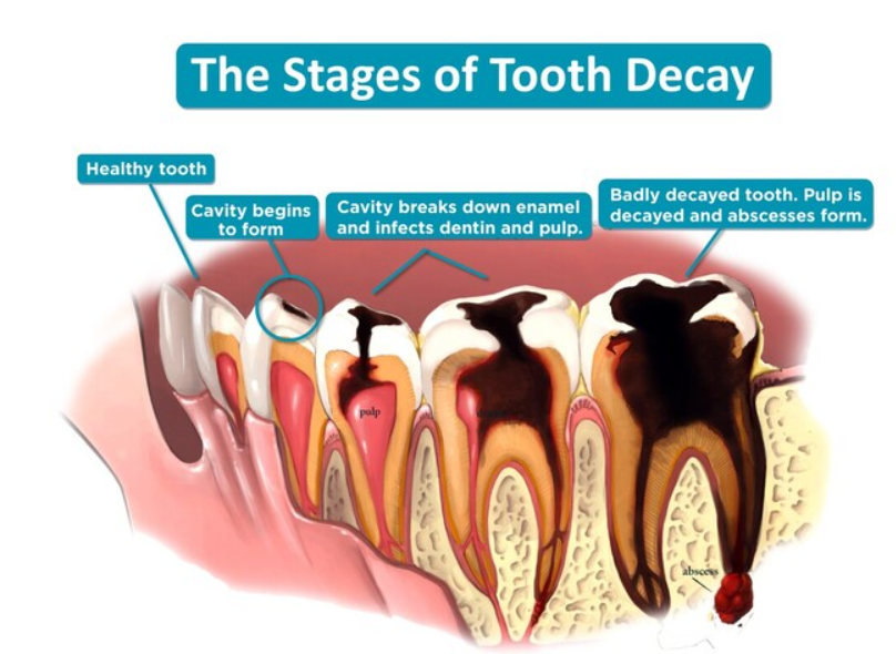<ol><li><p>dental caries AKA tooth decay</p></li></ol><p></p>