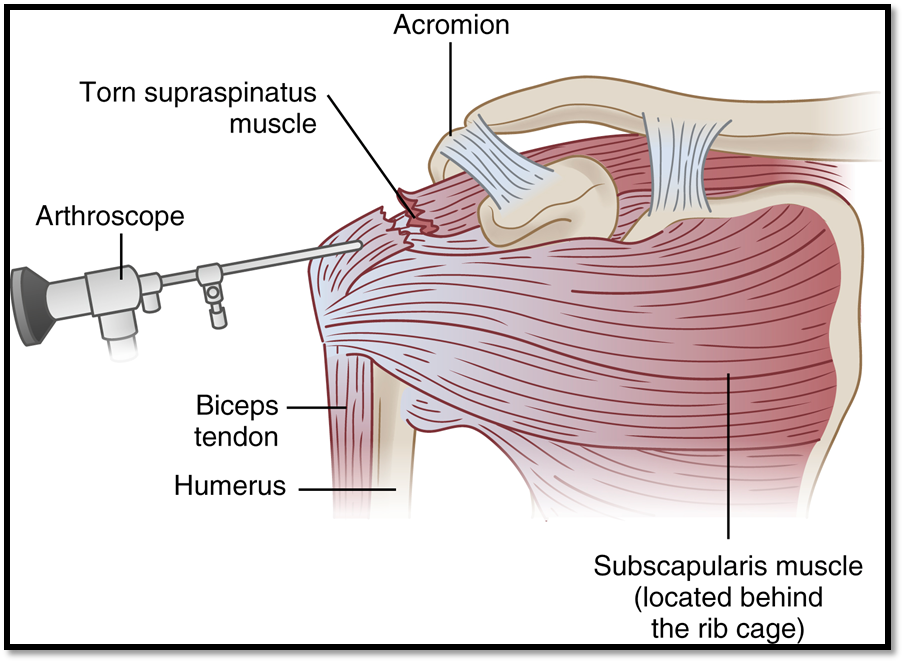 <p><span>•A tear in the shoulder</span></p><p></p><p><span>•</span><strong><u><span>Signs/Symptoms: </span></u></strong><span>shoulder weakness and severe pain, decreased ROM</span></p><p></p><p><span>•</span><strong><u><span>Complications: </span></u></strong><span>Frozen shoulderà arthrofibrosis</span></p><p></p><p><span>•</span><strong><u><span>Diagnostics: </span></u></strong><span>Drop arm test, MRI</span></p><p></p><p><span>•</span><strong><u><span>Treatment: </span></u></strong><span>Rest, ice, heat, NSAIDs, Corticosteriods, surgery, sling</span></p><p></p><p><span>•</span><strong><u><span>Nursing Care: </span></u></strong><span>restrict heavy lifting, pendulum exercises</span></p>