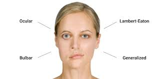 <p><strong>A 22-year-old female college student is shocked to receive a diagnosis of myasthenia gravis. What are the etiology and most likely treatment for her health problem?</strong></p><p>A) Autoimmune destruction of skeletal muscle cells; treatment with intensive physical therapy and anabolic steroids</p><p>B) A decline in functioning acetylcholine receptors; treatment with corticosteroids and intravenous immunoglobulins</p><p>C) Cerebellar lesions; surgical and immunosuppressive treatment</p><p>D) Excess acetylcholinesterase production; treatment with thymectomy</p>