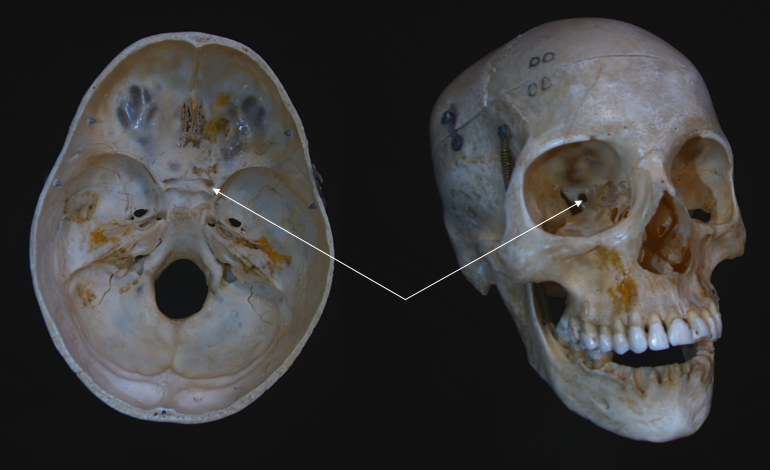 optic foramen 