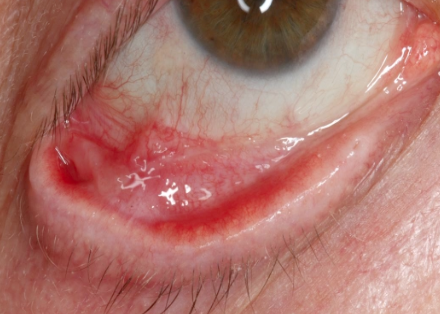 <p>What is Symblepharon?</p>