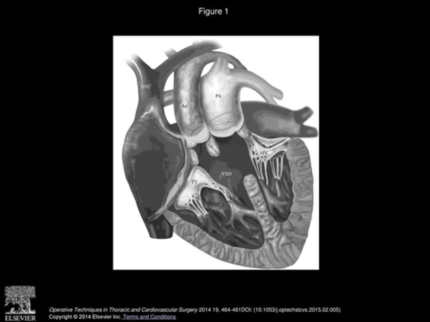 <p>more complicated version of DORV bc has subpulmonic VSD.</p><p>Pulmonary valve is overriding the VSD and the aorta is coming from the RV.</p><p>Treatment is switch procedure with closure of VSD.</p>
