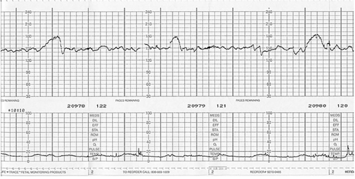 <ul><li><p>Temporary increase in the fetal heart rate that is reassuring </p><ul><li><p>>= 32 weeks: increase of >= 15 bpm that lasts >= 15 seconds (15 × 15)</p></li><li><p>< 32 weeks: 10 × 10 </p></li></ul></li><li><p>Causes </p><ul><li><p>Adequate oxygenation </p></li><li><p>Responsive autonomic nervous system </p></li><li><p>Fetal well being </p></li><li><p>Fetal movement/stimulation </p></li></ul></li><li><p>Absence is not abnormal but may require additional monitoring </p></li></ul><p></p><p></p>