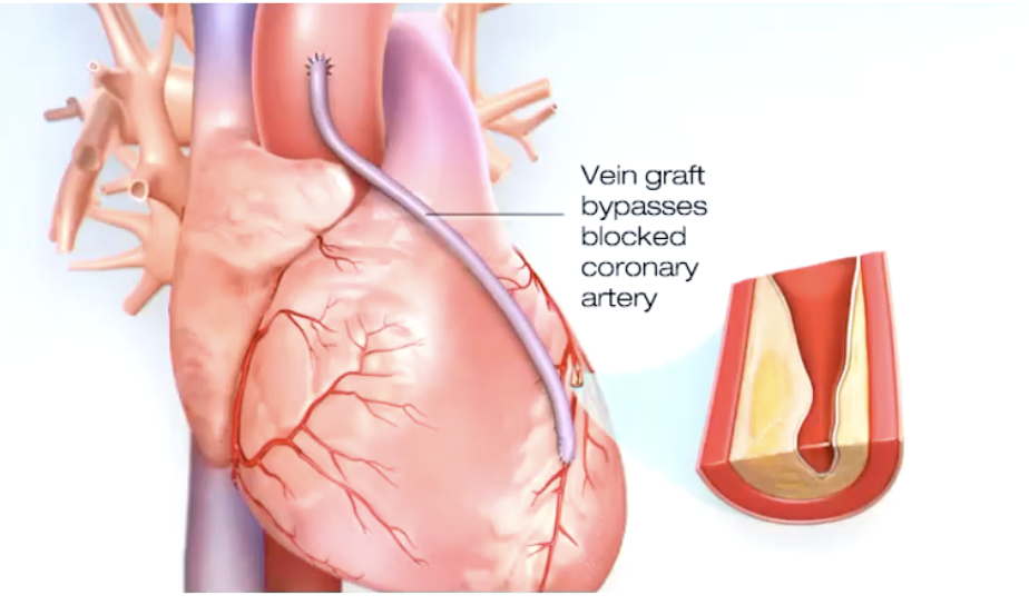 <p>treats blocked heart arteries by creating new passages for blood to flow to your heart muscle. It works by taking arteries or veins from other parts of your body (grafts) and using them to reroute blood around the clogged artery</p>
