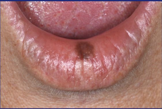 <p>‘A circumscribed flat area of discoloration <10mm diameter’, non palpable</p>