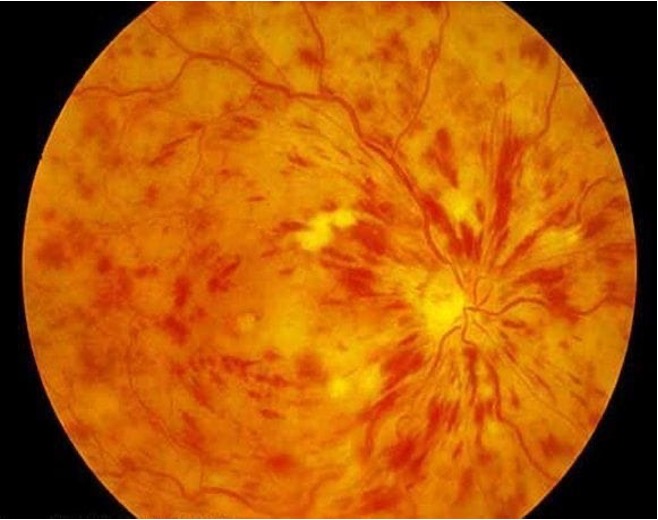 <p>What is this patient likely experiencing?</p><p></p><p>Sudden, painless, monocular loss of vision</p><p>The patient is 89 years of age and has hypertension</p><p>The patient thinks they had some black spots in their vision a few days ago, but can’t remember very well</p><p>Affected eye has gone blurry, with a VA of 6/18</p><p>Affected eye demonstrates a slight RAPD</p><p>The patient reports metamorphopsia</p>