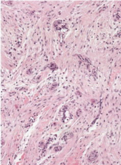 <p>Mature Fibrous Tissue</p><p>Occasional Odontogenic Epithelial Rests but not a neoplastic part of the tumour</p>