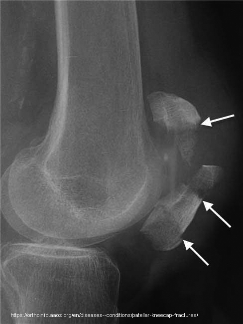 <p>Avascular necrosis, neurovascular injury.</p>