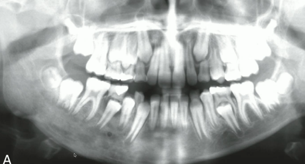 <p>what is the likely diagnosis of the lesion in the right mandible </p>