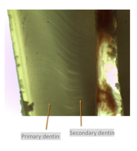 <p><span>It is formed once the root formation is completed.<br>• Similar structure to primary dentin although less<br>regular and mineralized.<br>• A slight change in the direction of the dentinal<br>tubules occurs when secondary dentin<br>formation begins.<br>• A rest line can be observed between primary<br>and secondary dentin.</span></p>