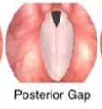 <p>apart near arytenoids</p>