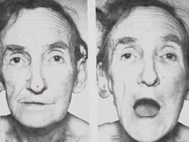 <p>trouble chewing, atrophy of ipsilateral cheek, mandible deviated to atrophied side</p>