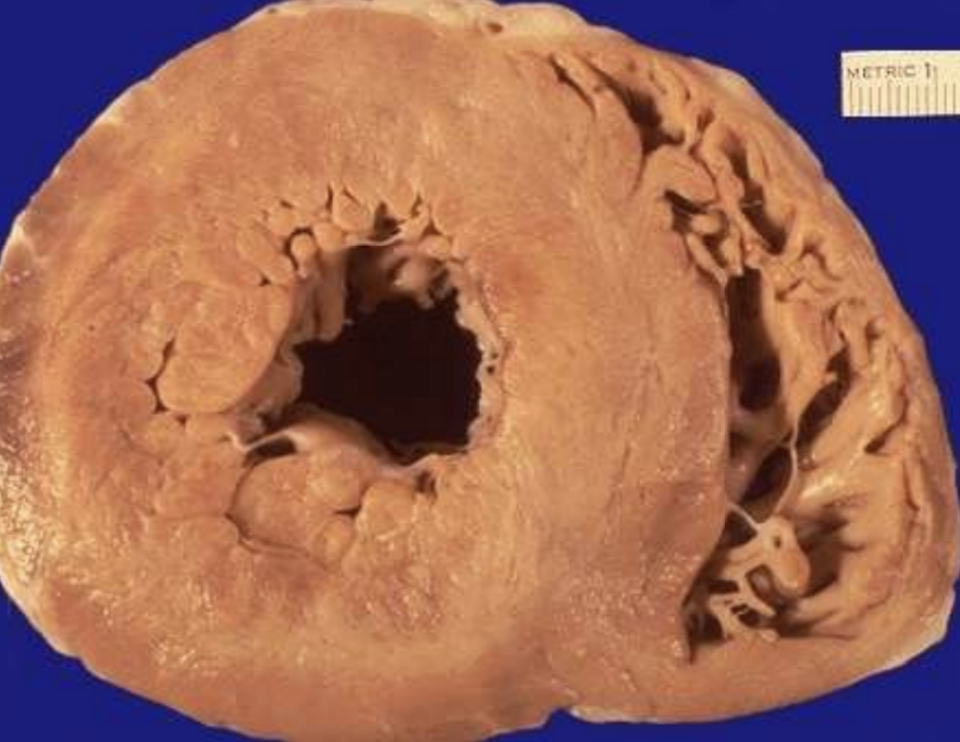 <p>Concentric Left Ventricular Hypertrophy</p>