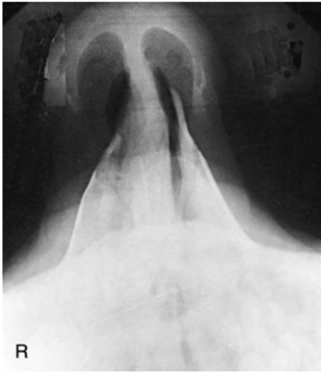 <p>-Position:</p><p>• No patient rotation is evident, as indicated by equal distance from anterior nasal spine to outer soft tissue borders on each side.</p><p>• Incorrect neck position is indicated by visualization of alveolar ridge (excessive extension) or visualization of too much glabella (excessive flexion).</p>