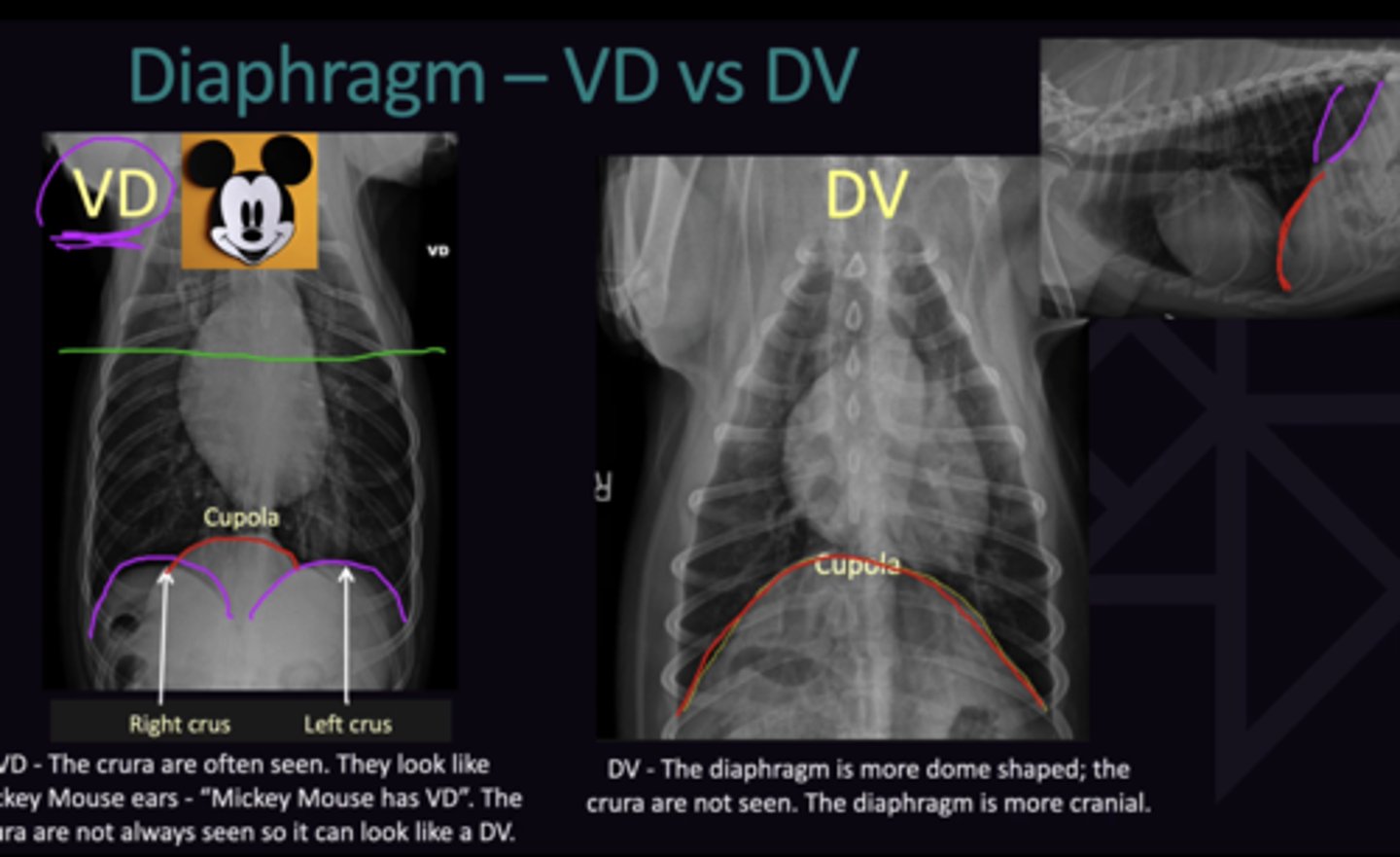 <p>Cannot Determine for Certain</p><p>1. Crura are often seen, and look like "Micky Mouse" ears. However not always seen</p><p>2. Diaphragm is more dome shaped; crura are not seen, diaphragm is more cranial</p>