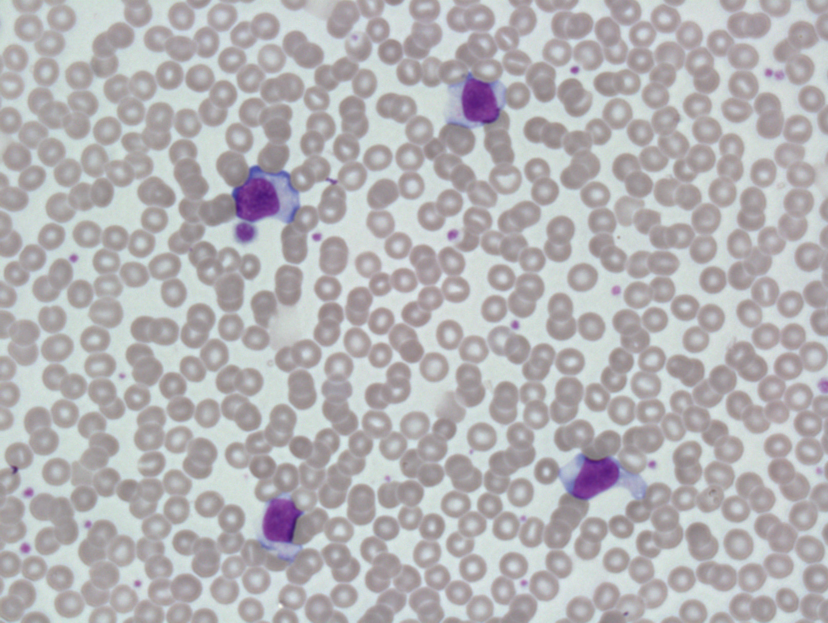 <p>What conditions is caused by <strong>EBV </strong>and is accompanied by an increase in <strong>reactive lymphocytes</strong>?</p>