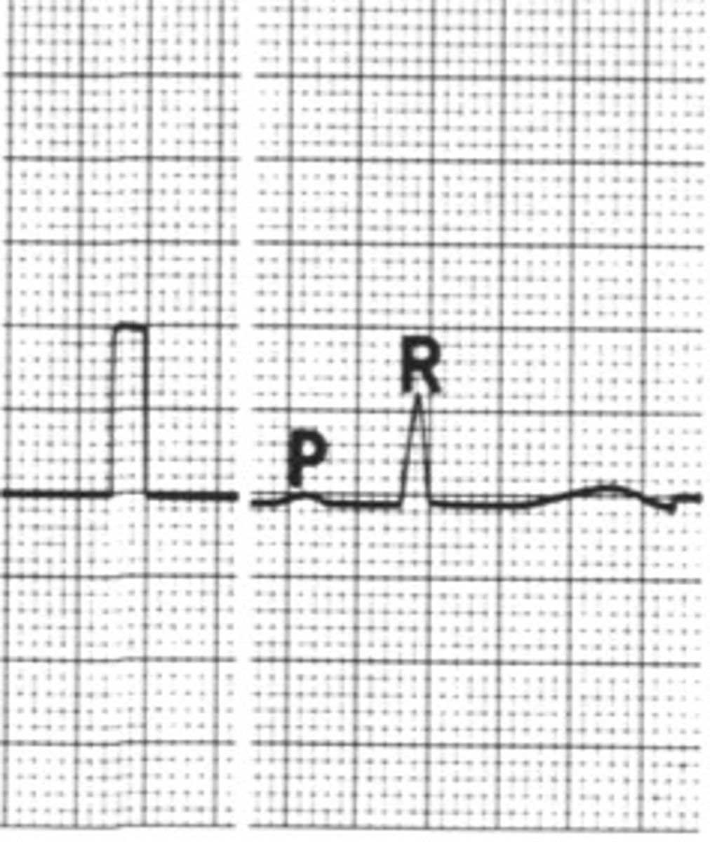 <p>What is the sensitivity of this if I tell you 1 cm = 1 mV</p>