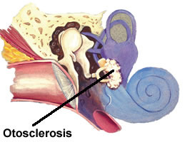 hardening of the bony tissue of the middle ear
- stapes can no longer move
- lose ability to hear low frequencies
- Treatment: Hearing aid, stapes replacement (stapedectomy)
