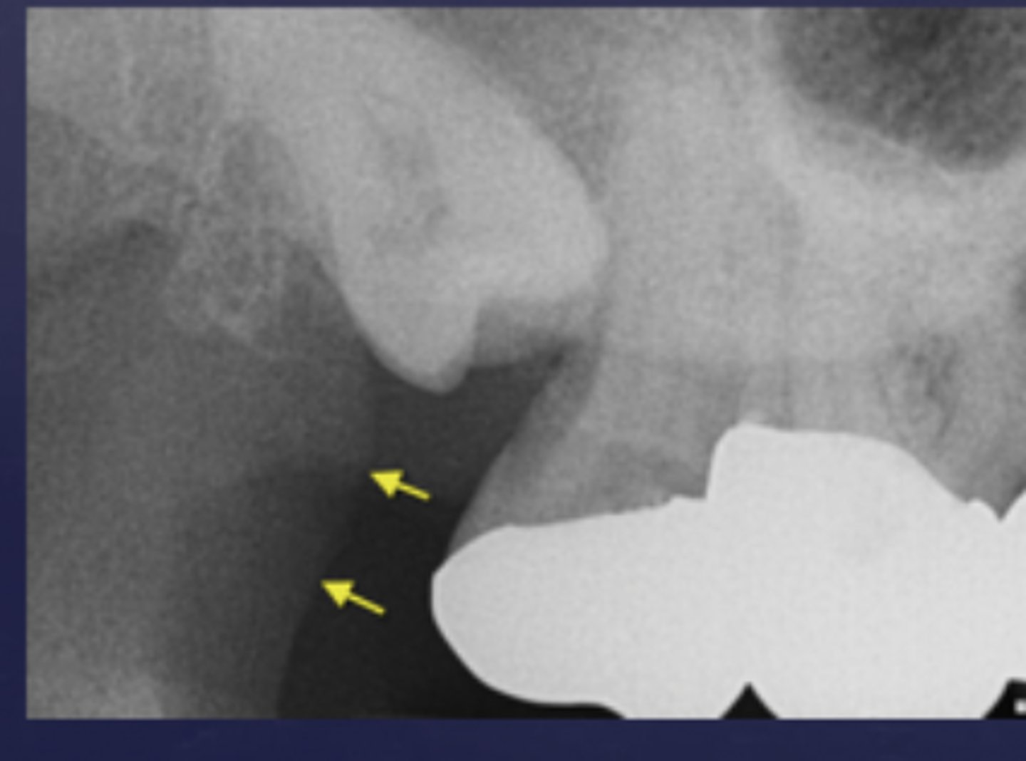 <p>bone seen on films taken in the far back of a pts mouth</p><p>radiopaque</p>