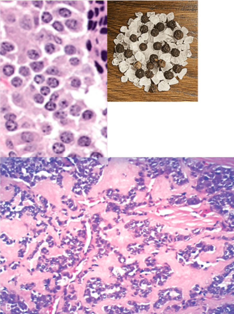 <p>Define Condition:</p><p>Malignant proliferation of parafollicular "C" cells</p><p>-Hx:</p><p>&gt; 70% are SPORADIC (nonhereditary)</p><p>&gt;&gt; Ages 40-60</p><p>&gt;&gt; Solitary</p><p>&gt; 30% are FAMILIAL (hereditary)</p><p>&gt;&gt; Younger (mean = 35 y/o)</p><p>&gt;&gt; Bilateral and Multicentric</p><p>&gt;&gt; Seen w/ Multiple Endocrine Neoplasia (MEN) Syndrome 2A and 2B but not associated</p><p>&gt;&gt; ALL a/w RET mutations</p><p>-Path: More CALCITONIN --&gt; ↓ serum Ca2+ by inhibiting osteoclasts (↓bone resorption) and ↓ kidney Ca2+ reabsorption, but not important in normal Ca2+ homeostasis</p><p>&gt; Altered Calcitonin Deposits ==&gt; AMYLOID DEPOSITS</p><p>-Dx:</p><p>&gt; Gross: Solid, Gray-Tan yellow</p><p>&gt; Micro:</p><p>&gt;&gt; Polygonal to spindle-shaped tumor cells arranged in nests, cords, or glands</p><p>&gt;&gt; Round nuclei with finely stippled to coarsely clumped chromatin (“Salt and pepper” chromatin)</p><p>&gt;&gt; Amyloid deposits in stroma (homogeneous pink extracellular material -&gt; stains red on Congo red stain and shows apple green birefringence under polarized light)</p><p>&gt;&gt; Tumor cells AND Amyloid = (+) CALCITONIN IHC Stain</p>