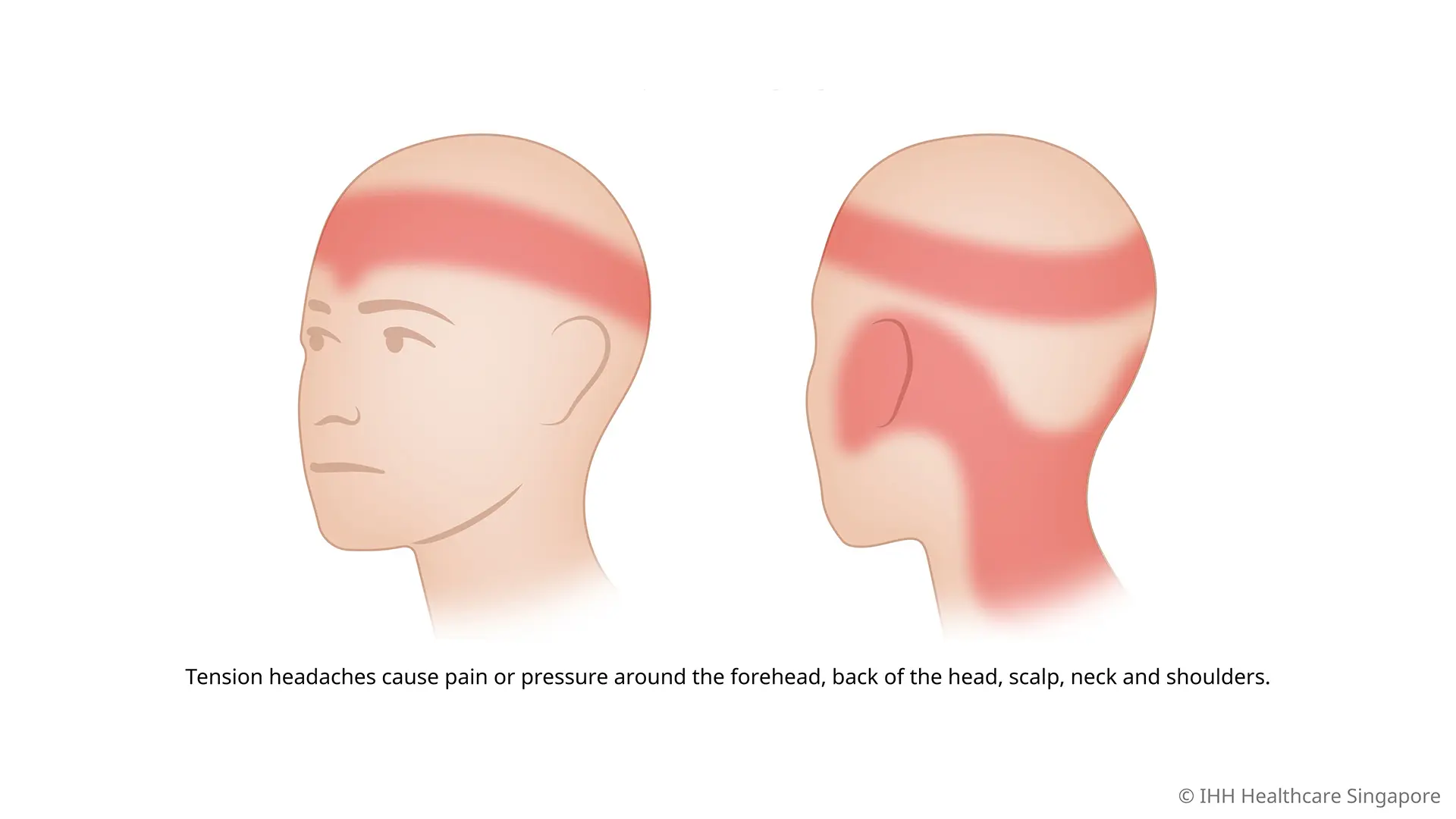 <ol><li><p>triggers: stress, anxiety, depression, poor sleep</p></li><li><p>associated symptoms: fatigue, anxiety, stress, sensation of a band of tightening around head </p></li></ol><p></p>
