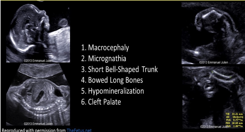 <p>bowing of the long bones, especially the bones of the lower leg, is indicative of</p><p>.</p><p>. lethal short-limbed dwafism </p><p>.</p><p>a) ellis van creveld syndrome</p><p>b) radial ray anomalies</p><p>c) campomelic dysplasia</p><p>d) holt oram syndrome</p>