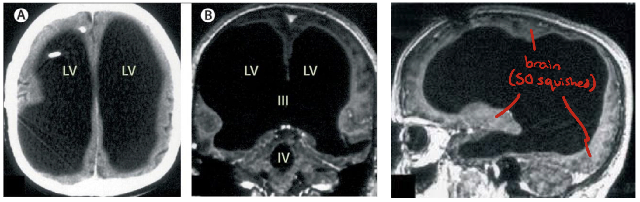 <ul><li><p><strong>Significantly </strong>enlarged ventricles</p><ul><li><p>HUGE and filled with CSF, took up ~90% of the space within his skull</p></li></ul></li><li><p>Remaining brain matter compressed to the areas right around his skull</p><ul><li><p>SEVERE squishing</p></li></ul></li></ul><p></p>