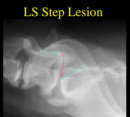 <p>Lumbosacral Instability </p>