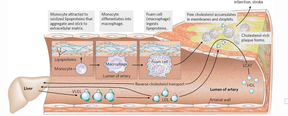 <p>- Atherosclerosis results in narrowing of blood vessels</p><p>- this is a major cause of heart attack and stroke</p><p>.</p><p>- when we have imbalance between the LDL and HDL, HDL cant remove sufficient amounts of these LDL, resulting in increased concentration of these LDL in circulation</p><p>- these can stick or aggregate to extracellular matrix and they can oxidise</p><p>- this attracts monocytes which differentiate into macrophages and they will ingest these lipoproteins and become foam cells</p><p>- endothelium becomes more permeable to the lymphocytes and monocytes and so these cells migrate into the vessel wall</p><p>- this will attract more LDL which migrates into the cholesterol wall (which accumulates which we call a plaque)</p><p>.</p><p>- anothrer serious thing that can happen is that the macrophages at the centre of the plaque can die and we have formation of necrotic core and fibrous cap</p><p>- hence this fibrous cap can cause thrombosis</p>