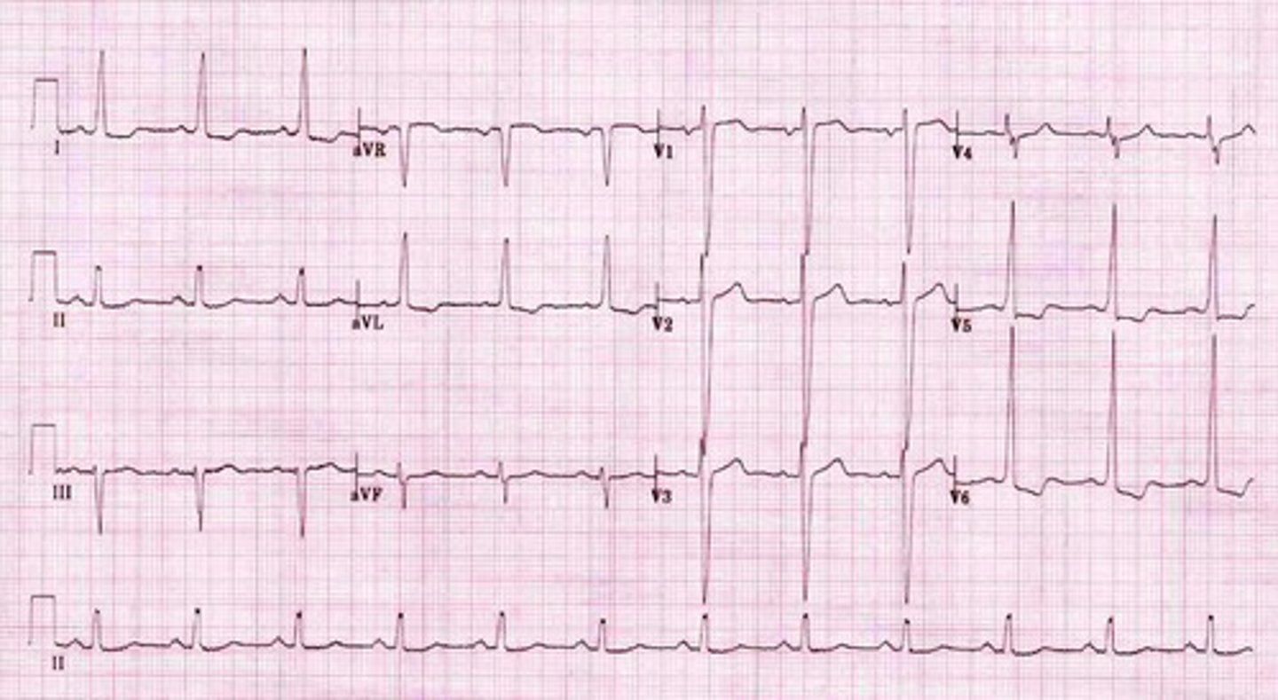 <p>- sokolow-lyon criteria </p><p>- R wave taller than 11 mm in aVL </p><p>- appropriate discordance (ST elevation in V2-V3 most common) </p>