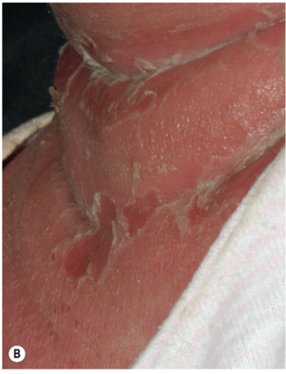 <p>Exfoliative toxin A - bullous impetigo</p><p>Exfoliative toxin B - circulates to distant sites and causes scalded skin syndrome</p>