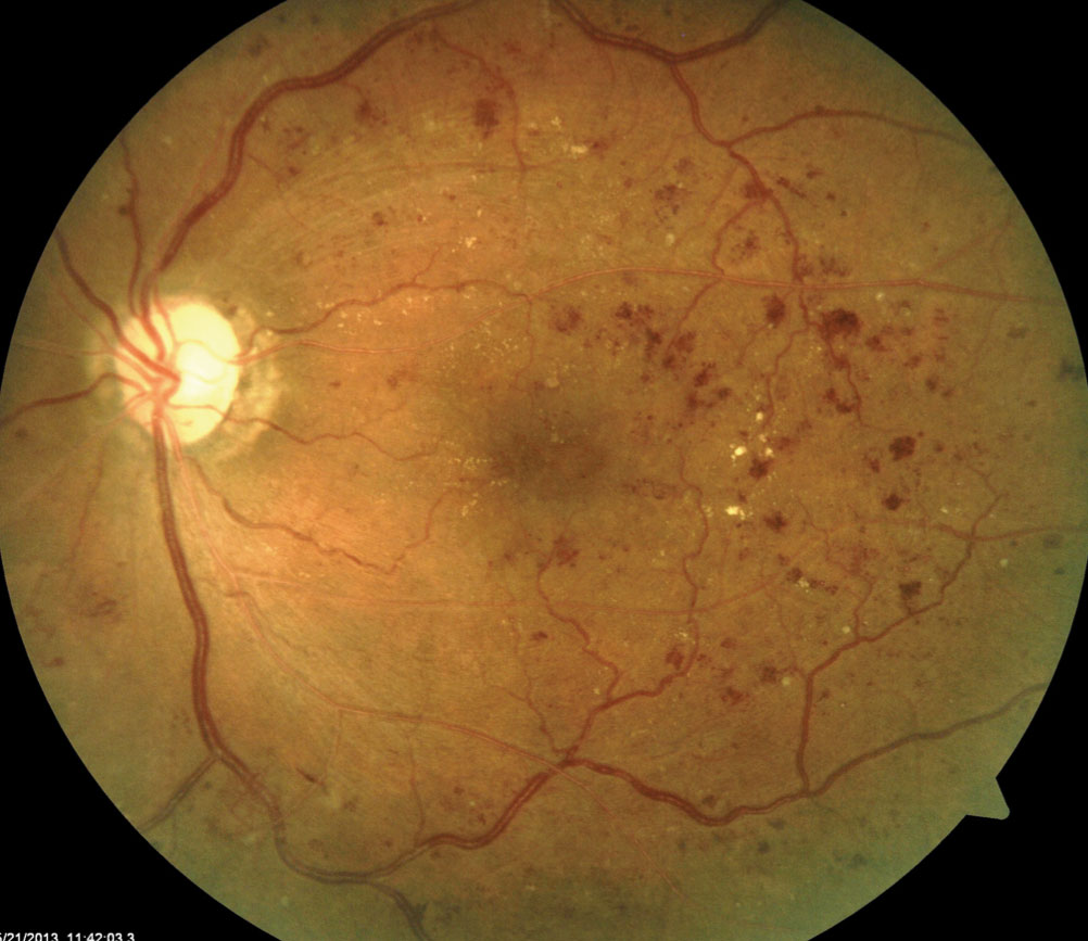 <p>PP: deeper hemorrhages<br>dot/blot hemorrhages</p><p>E: macular edema<br>cotton wool spots</p><p>CM: ischemia→neovascularization (new blood vessel growth)</p>