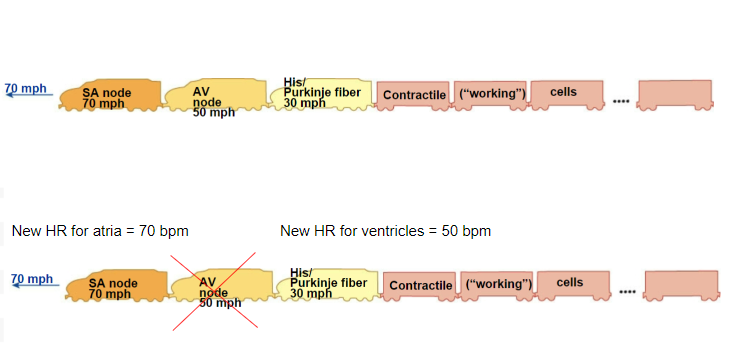 <p>SA node is still going 70, but no communication to the other parts of the heart.</p><p>Other parts of heart (HIS &amp; Purkinje) still working, but at 30. Atria going 70bpm, but ventricles going 30bpm.</p><p>Heart still works but is inefficient</p>