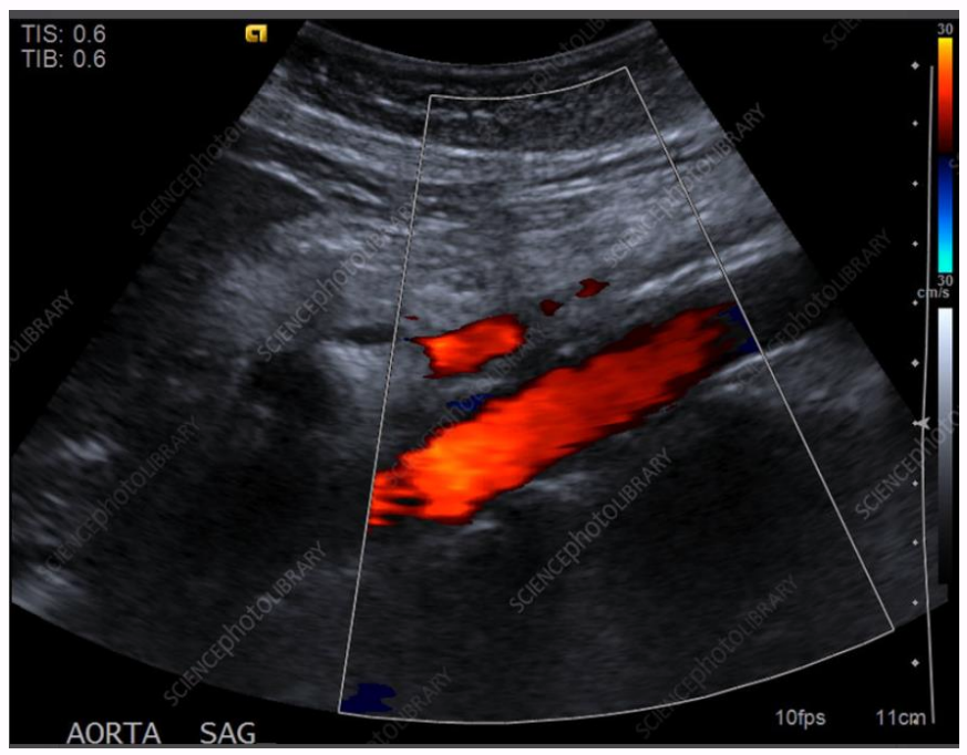 <p>the direction of flow in this aorta is</p>