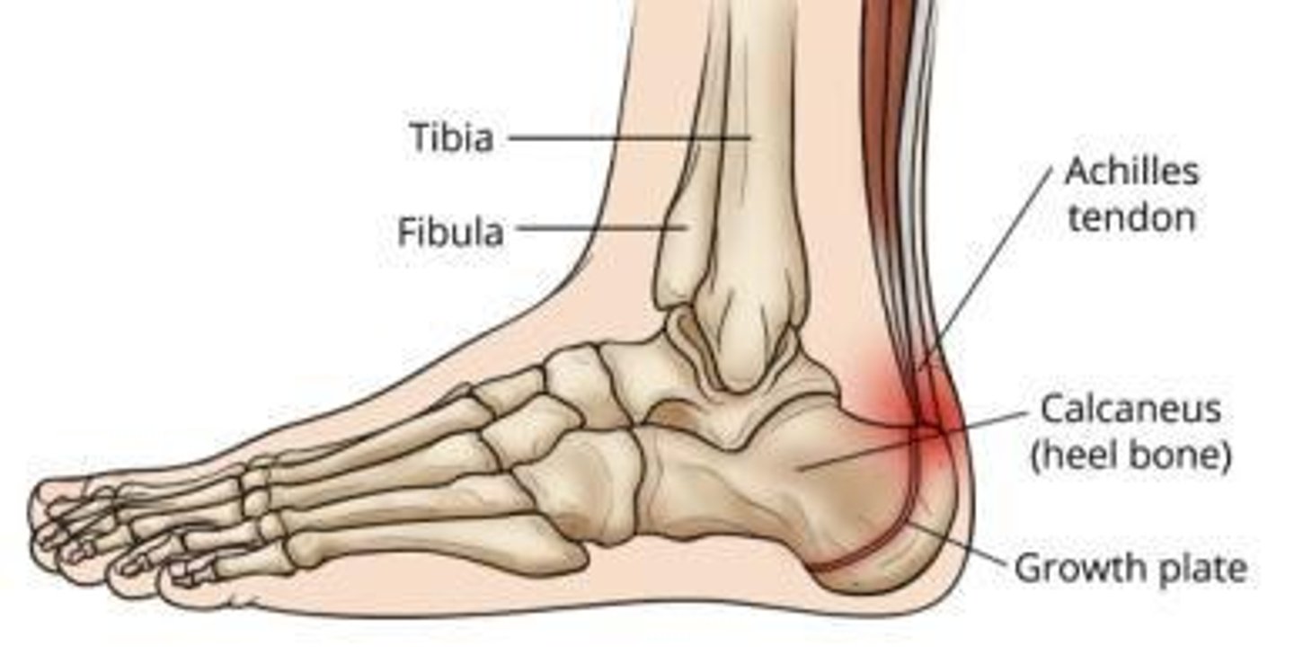 <p>A condition in the anterior shin where repeated trauma leads to bony formation in the anterior tibial muscle and sometimes the fibular muscle group.</p>
