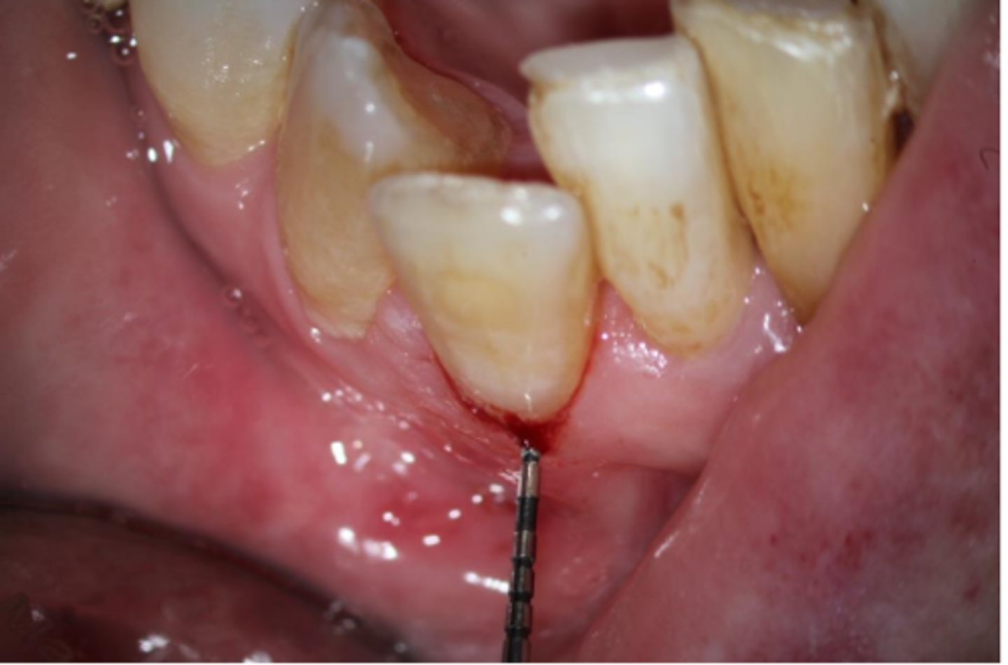 <p>A patient presents asymptomatic with a pink spot in the cervical aspect of the tooth, near the gingival margin. Upon probing, the pocket is hemorrhagic and feels hard/scratchy. What is the most likely diagnosis? </p>
