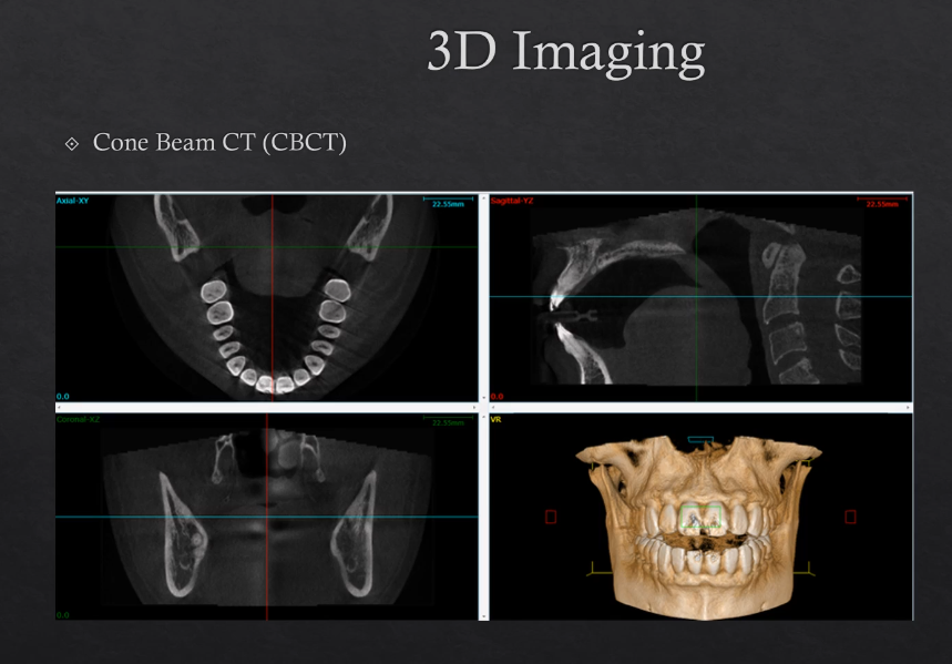 <ul><li><p>cone beam CT , CBCT </p></li><li><p>Uses more Xrays from different angles - this contributes to a higher dose </p></li><li><p>modern technique</p></li><li><p> can be used to make 3D models</p></li></ul><p></p>