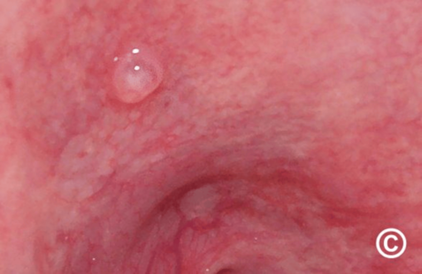 <p>Lesion formed when salivary gland duct is severed & the mucous salivary gland secretion spills into the adjacent connective tissue; Most often seen on lower lip; NOT A TRUE CYST because it is NOT lined with epithelium</p>